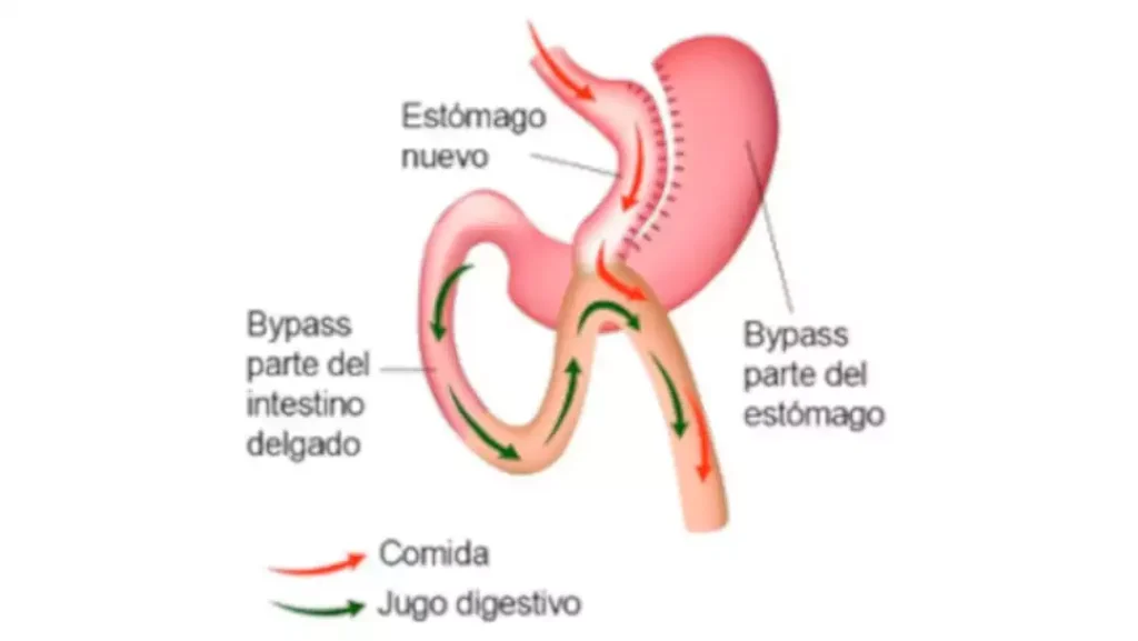 Mini bypass gastrico