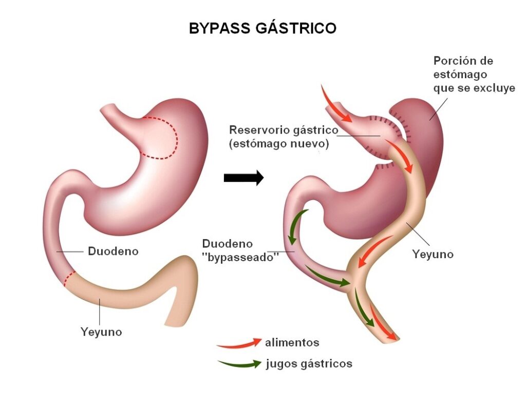 Cirugía de revisión de Bypass Gástrico